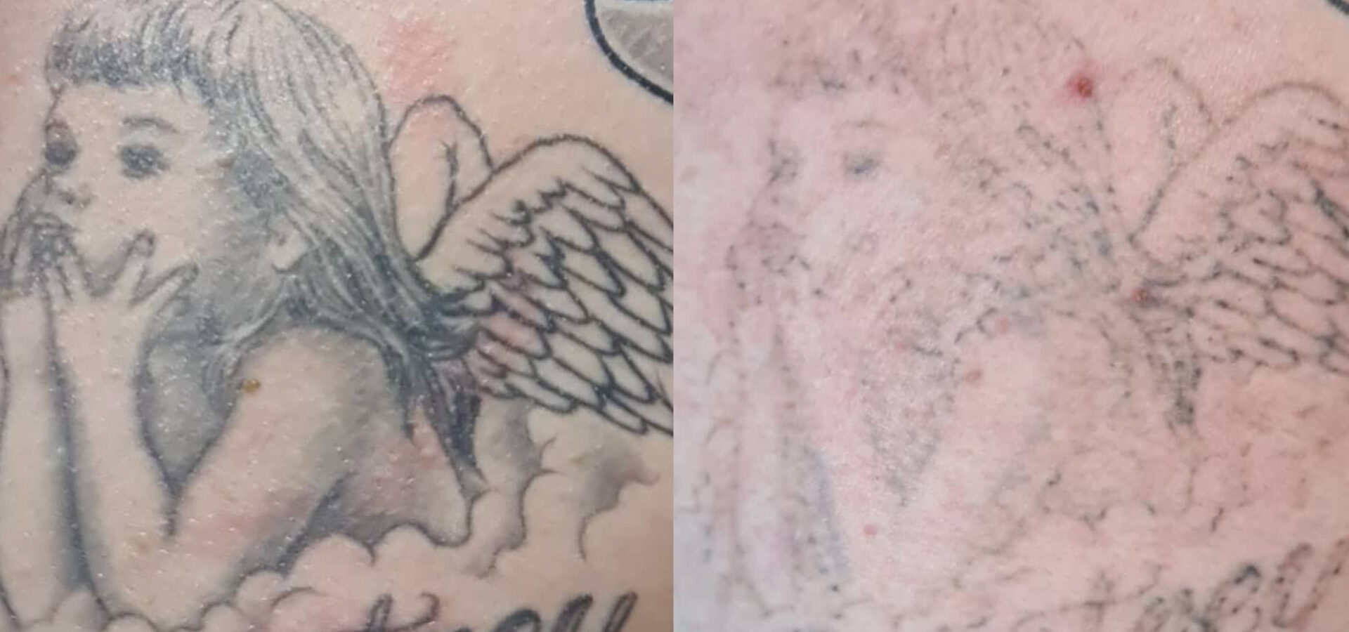 Laser Removal Banner image Old Sarum Tattoo
