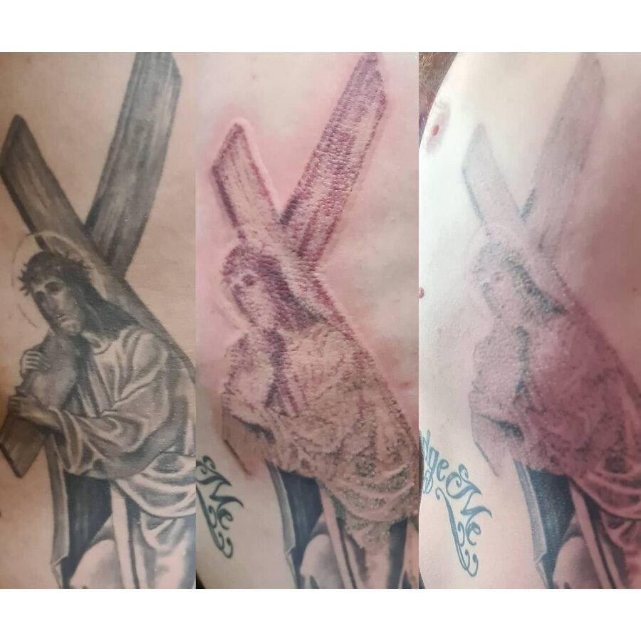 Old Sarum Tattoo Loki Laser tattoo removal example 2