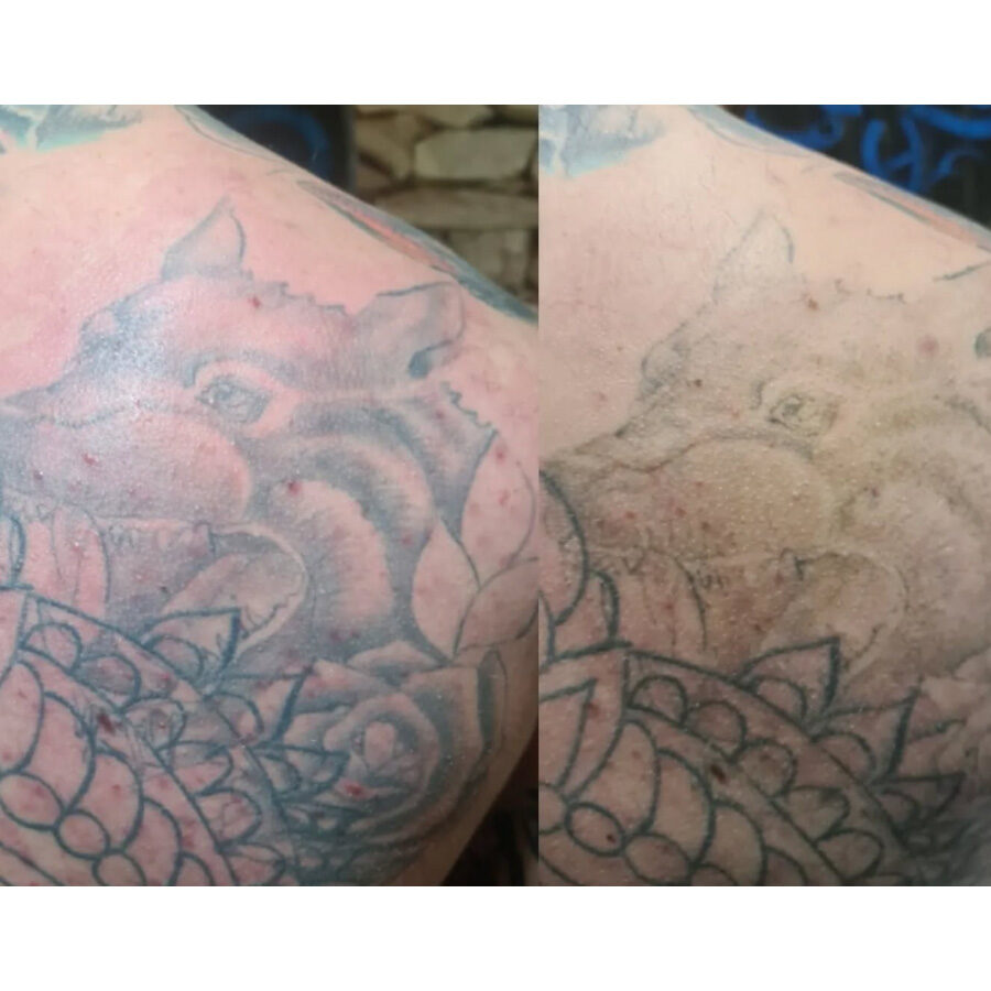 Old Sarum Tattoo Laser tattoo removal example 3